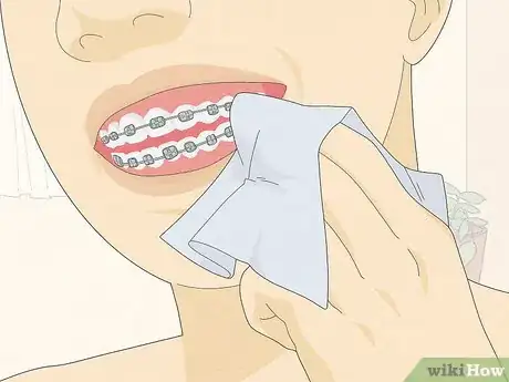 Immagine titolata Temporarily Fix a Loose Wire on Your Braces Step 6