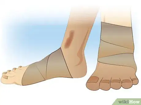 Immagine titolata Ace Wrap a Leg Step 8