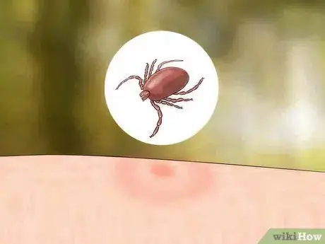 Immagine titolata Identify Insect Bites Step 5