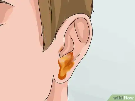 Immagine titolata Know if You Have Otitis Media Step 3