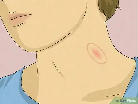 Immagine titolata Identify a Hickey Step 2