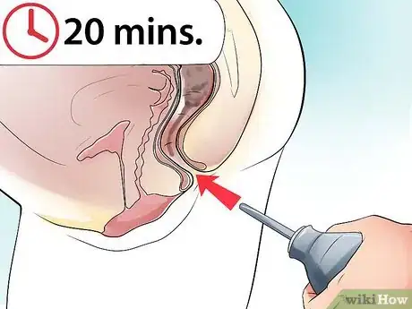 Immagine titolata Make an Enema Step 21