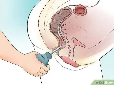Immagine titolata Make an Enema Step 16