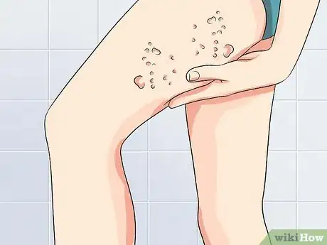 Immagine titolata Ease Herpes Pain with Home Remedies Step 35