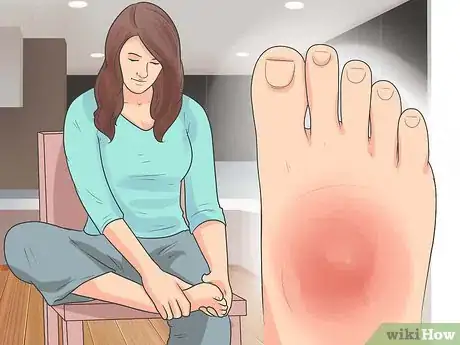 Immagine titolata Treat a Broken Foot Step 9