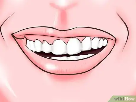 Immagine titolata Diagnose an Overbite Step 2