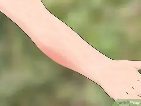 Immagine titolata Identify Insect Bites Step 3