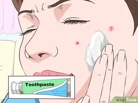 Immagine titolata Stop Mosquito Bites from Itching Step 10