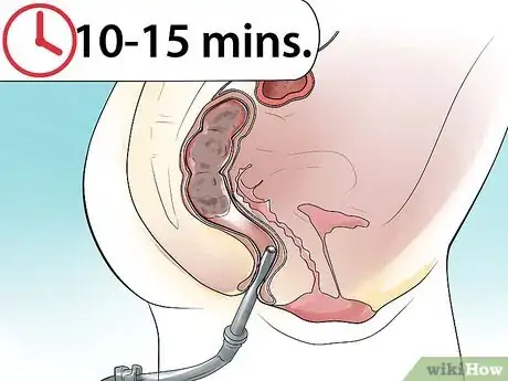 Immagine titolata Make an Enema Step 12