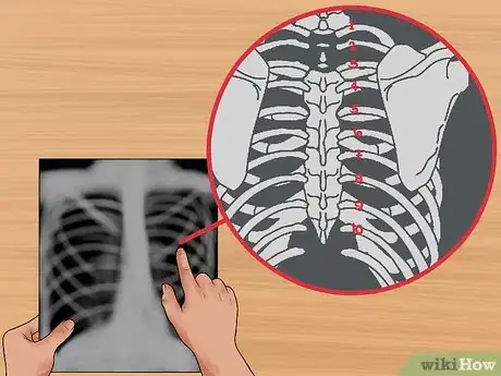 Immagine titolata Read a Chest X Ray Step 4