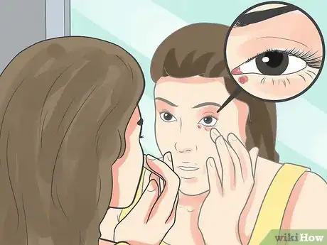 Immagine titolata Recognize an Eyelid Cyst Step 1