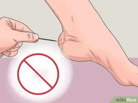 Immagine titolata Care for a Burst Blister Step 4