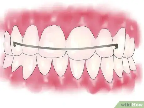 Immagine titolata Fix Crooked Teeth Step 5