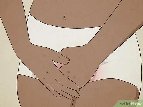 Immagine titolata Get Rid of a Bartholin Cyst Step 9