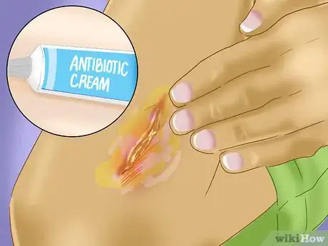 Immagine titolata Treat a Skin Flap or Abrasion During First Aid Step 6