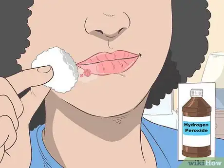 Immagine titolata Treat a Cold Sore or Fever Blisters Step 19