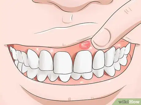 Immagine titolata Reduce Gum Swelling Step 1