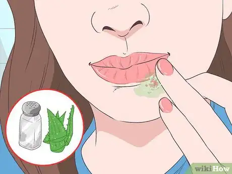 Immagine titolata Treat a Cold Sore or Fever Blisters Step 22