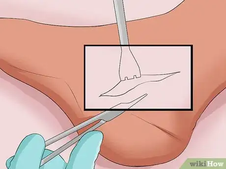 Immagine titolata Treat Plantar Fasciitis Step 11