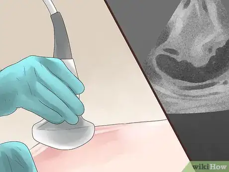 Immagine titolata Prevent Molar Pregnancy Step 8