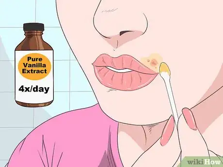 Immagine titolata Treat a Cold Sore or Fever Blisters Step 23