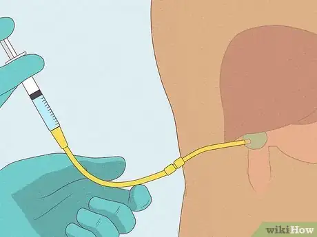 Immagine titolata Get Rid of Gallstones Step 13