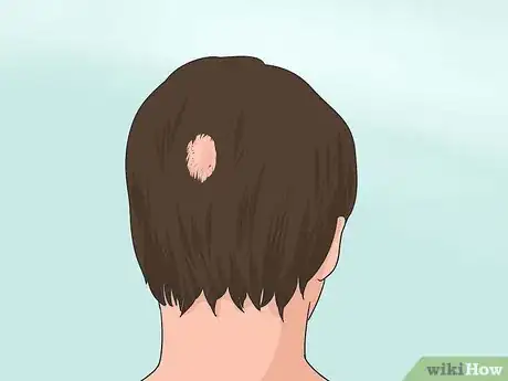 Immagine titolata Stop Teen Hair Loss Step 6