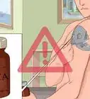 Rimuovere un Tatuaggio