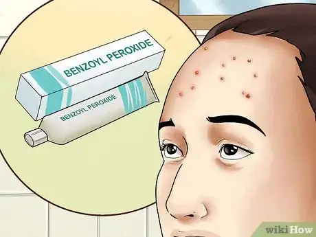 Immagine titolata Get Rid of Forehead Acne Step 1