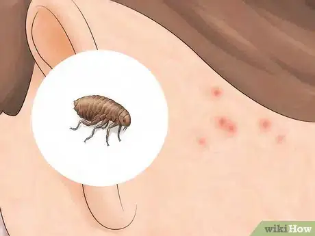 Immagine titolata Identify Insect Bites Step 6