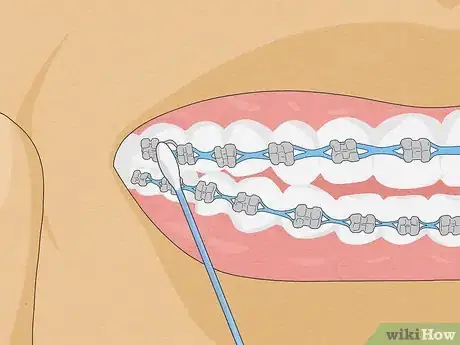 Immagine titolata Temporarily Fix a Loose Wire on Your Braces Step 3