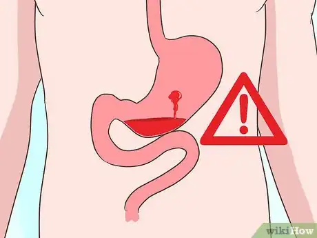 Immagine titolata Treat a Bleeding Ulcer Step 6