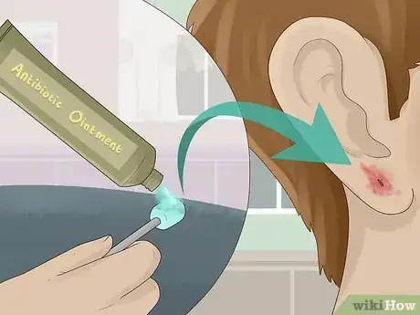 Immagine titolata Clean an Infected Ear Piercing Step 4