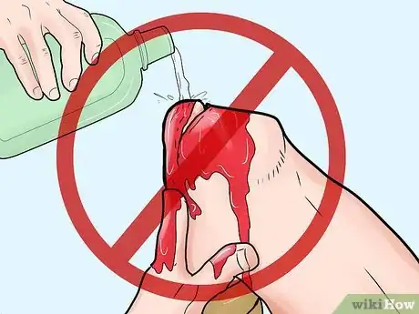 Immagine titolata Treat an Open Fracture During First Aid Step 5