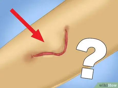 Immagine titolata Treat a Skin Flap or Abrasion During First Aid Step 4