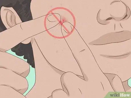 Immagine titolata Get Rid of a Zit Overnight Step 16