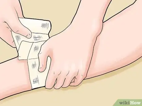 Immagine titolata Treat an Open Fracture During First Aid Step 6