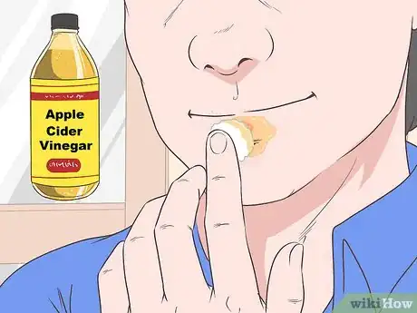 Immagine titolata Treat a Cold Sore or Fever Blisters Step 18