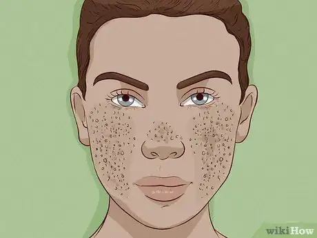 Immagine titolata Close Blackhead Holes Step 2