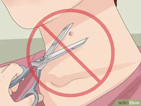 Immagine titolata Get Rid of Skin Tags Step 21