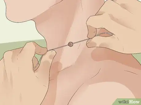 Immagine titolata Get Rid of Skin Tags Step 20