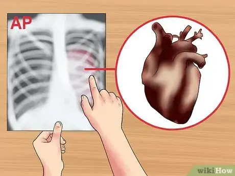 Immagine titolata Read a Chest X Ray Step 9