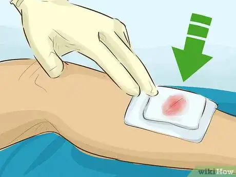 Immagine titolata Stop Bleeding Step 19