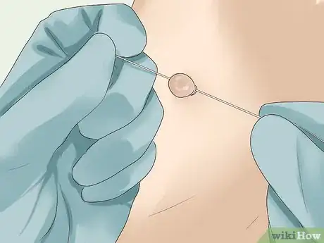 Immagine titolata Get Rid of Skin Tags Step 5