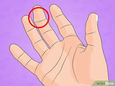 Immagine titolata Treat a Broken Finger Step 3