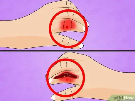 Immagine titolata Treat a Broken Finger Step 2