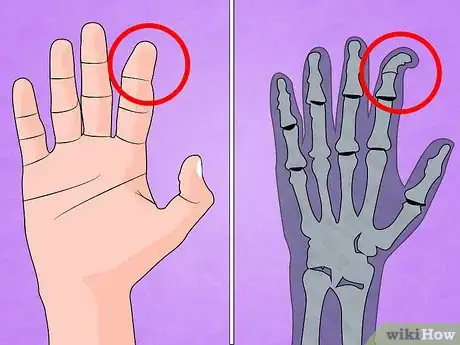 Immagine titolata Treat a Broken Finger Step 8
