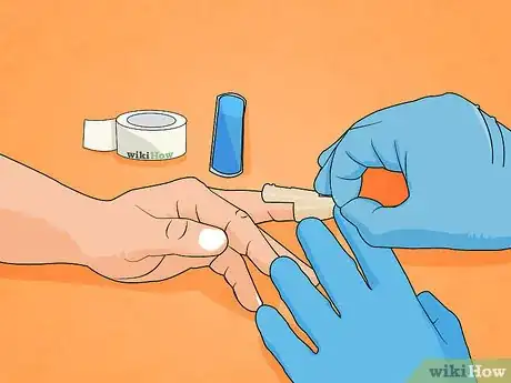 Immagine titolata Treat a Broken Finger Step 9