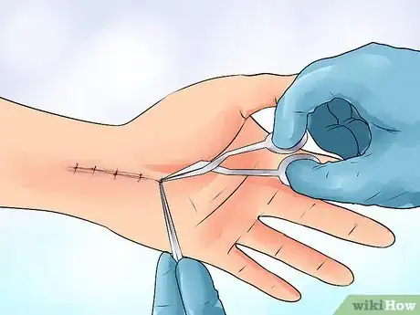 Immagine titolata Exercise After Carpal Tunnel Surgery Step 14