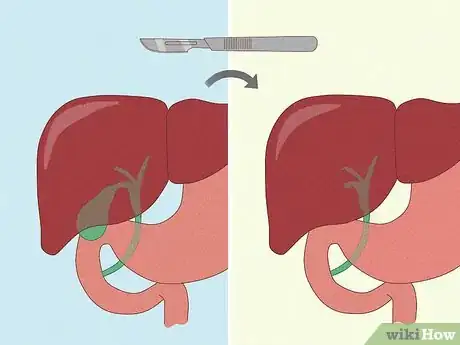 Immagine titolata Get Rid of Gallstones Step 15